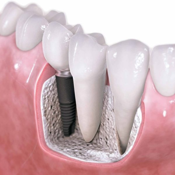 implantes dentales